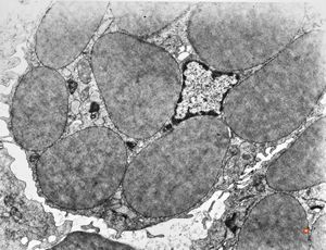 F,32y. | lymphadenopathy - clin. dysglobulinaemia